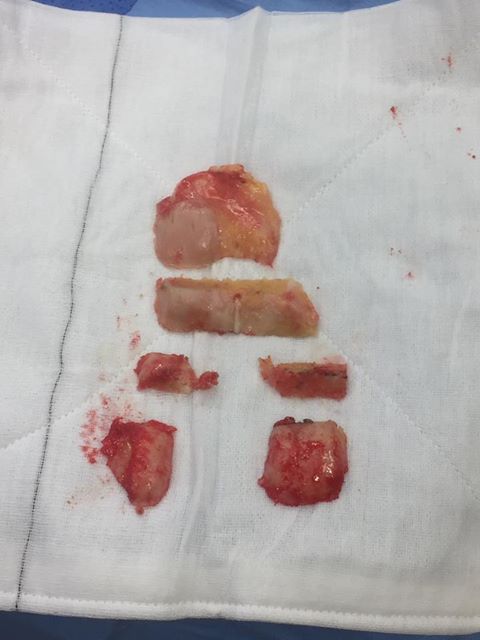 total knee replacement vs resurfacing
