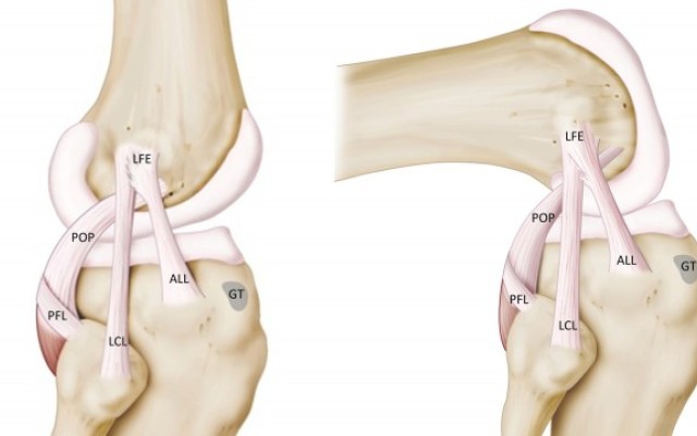 Antero-Lateral Ligament (ALL) Augmentation 