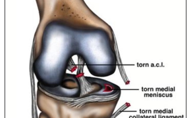 ACL rupture and associated structural injuries of the knee
