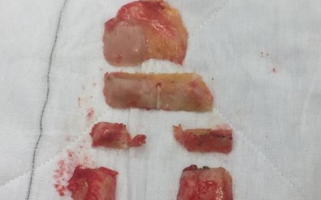 Total Knee Replacement vs Resurfacing